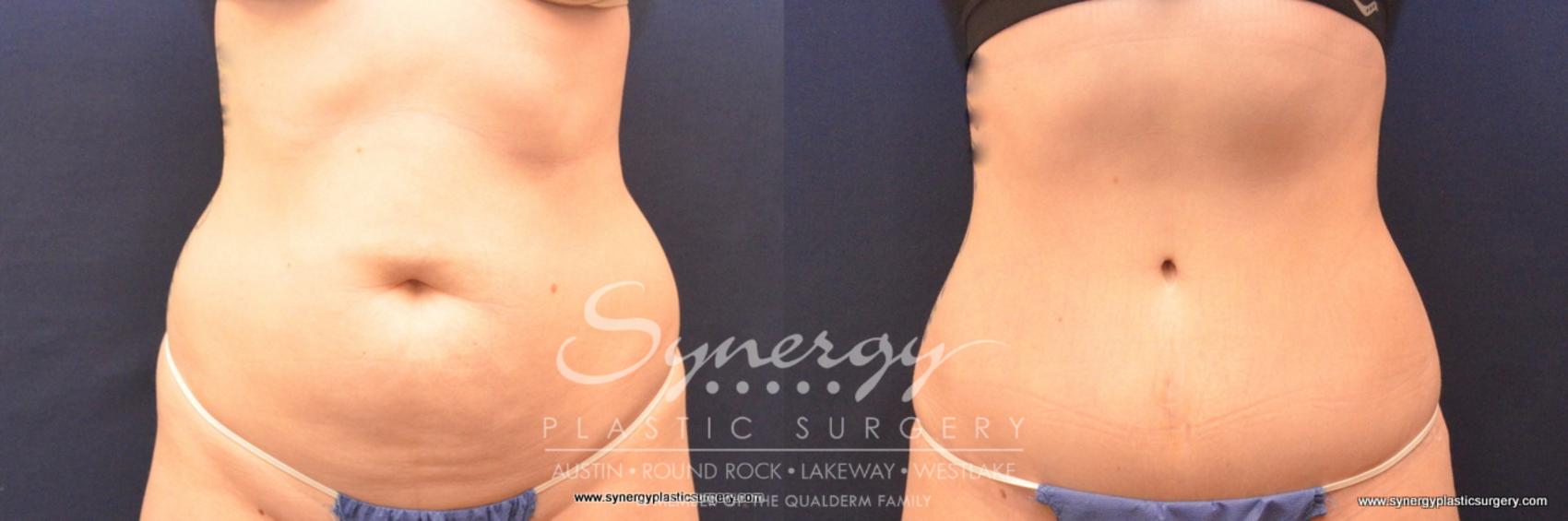 Before & After Abdominoplasty (Tummy Tuck) Case 789 View #1 View in Austin, TX