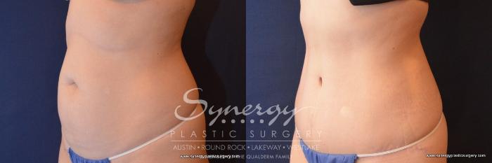 Before & After Abdominoplasty (Tummy Tuck) Case 789 View #2 View in Austin, TX