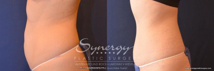 Before & After Abdominoplasty (Tummy Tuck) Case 789 View #3 View in Austin, TX