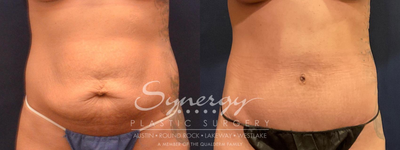 abdominoplasty, synergy plastic surgery 