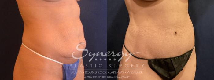 abdominoplasty, synergy plastic surgery 
