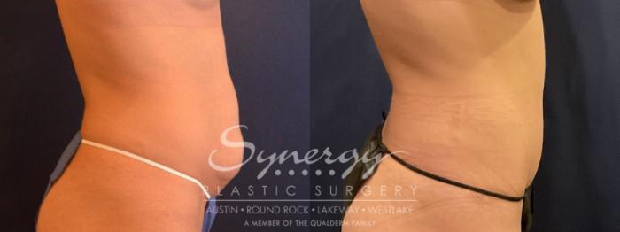 abdominoplasty, synergy plastic surgery 