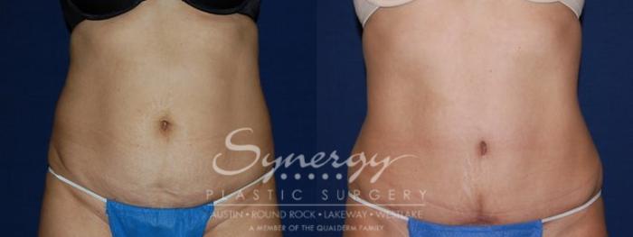 Before & After Abdominoplasty (Tummy Tuck) Case 81 View #3 View in Austin, TX