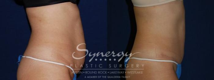 Before & After Abdominoplasty (Tummy Tuck) Case 81 View #4 View in Austin, TX