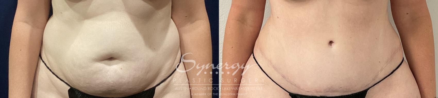 Before & After Abdominoplasty (Tummy Tuck) Case 862 Front View in Austin, TX
