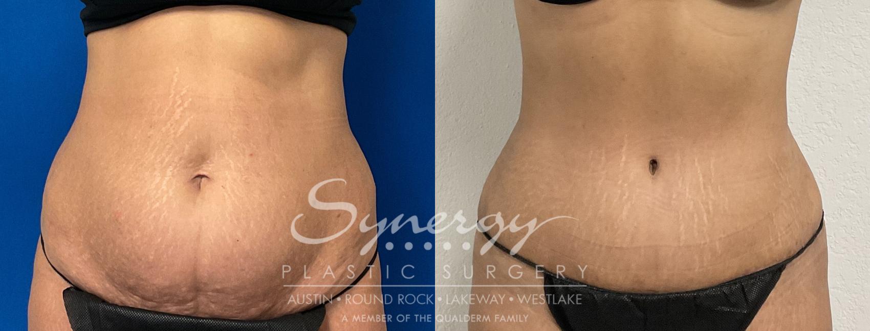 Before & After Abdominoplasty (Tummy Tuck) Case 868 Front View in Austin, TX