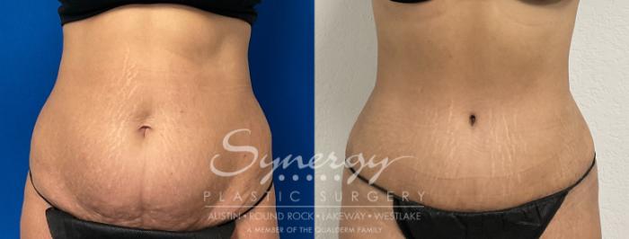 Before & After Abdominoplasty (Tummy Tuck) Case 868 Front View in Austin, TX
