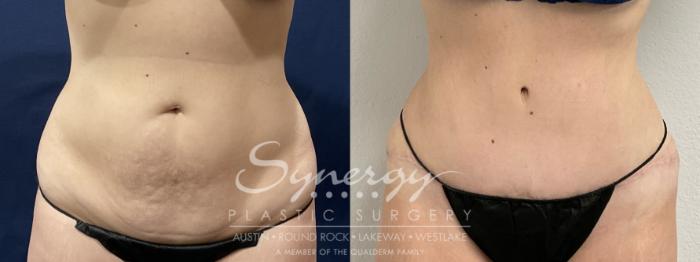 Before & After Abdominoplasty (Tummy Tuck) Case 871 Front View in Austin, TX