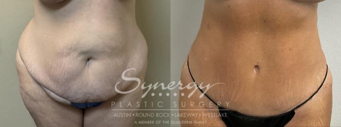Before & After Abdominoplasty (Tummy Tuck) Case 901 Front View in Austin, TX