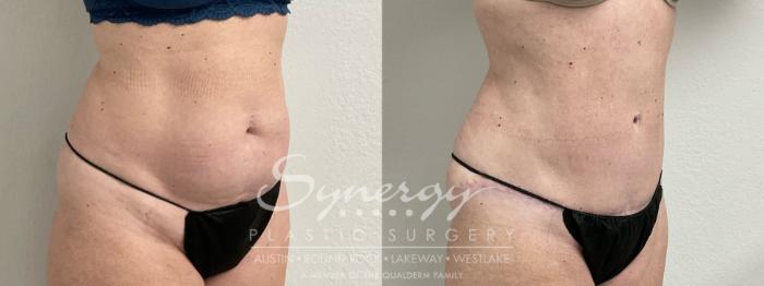 Before & After Abdominoplasty (Tummy Tuck) Case 907 Right Oblique View in Austin, TX