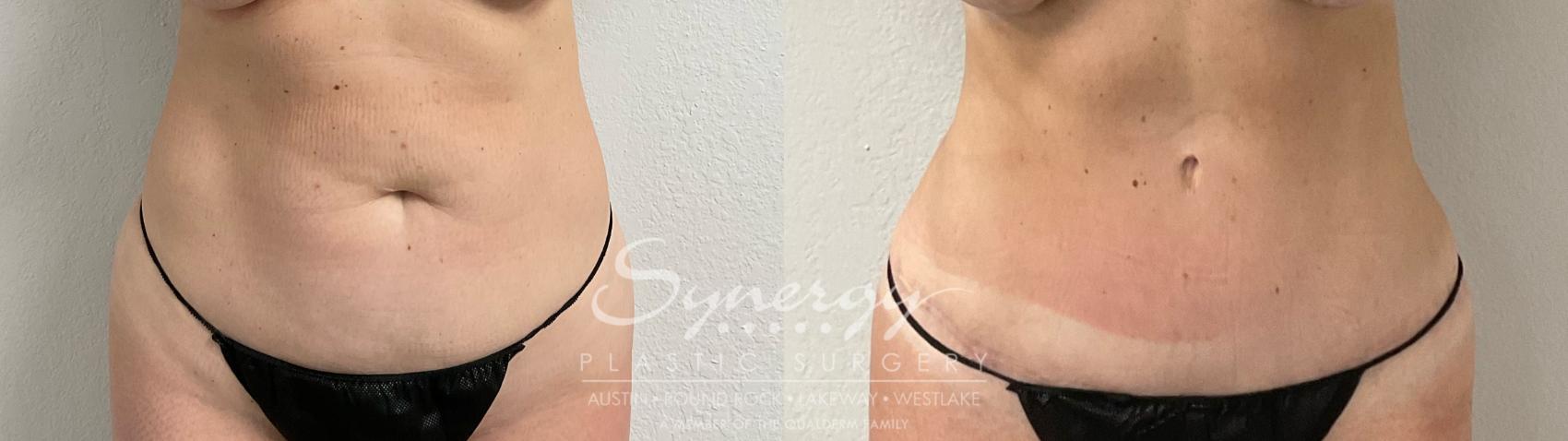 Before & After Abdominoplasty (Tummy Tuck) Case 913 Front View in Austin, TX