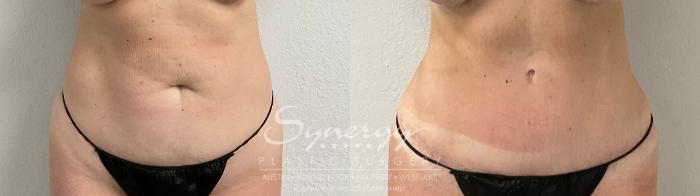 Before & After Abdominoplasty (Tummy Tuck) Case 913 Front View in Austin, TX