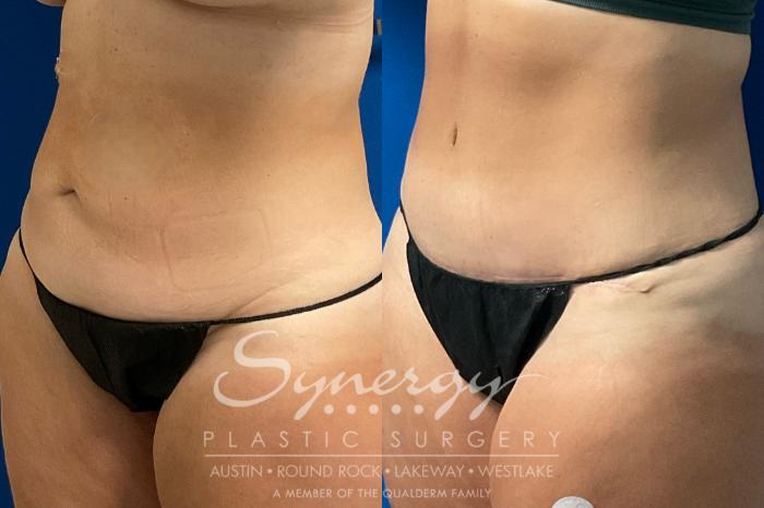 Before & After Abdominoplasty (Tummy Tuck) Case 932 Left Oblique View in Austin, TX