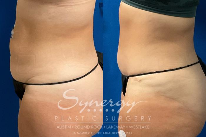 Before & After Abdominoplasty (Tummy Tuck) Case 932 Left Side View in Austin, TX