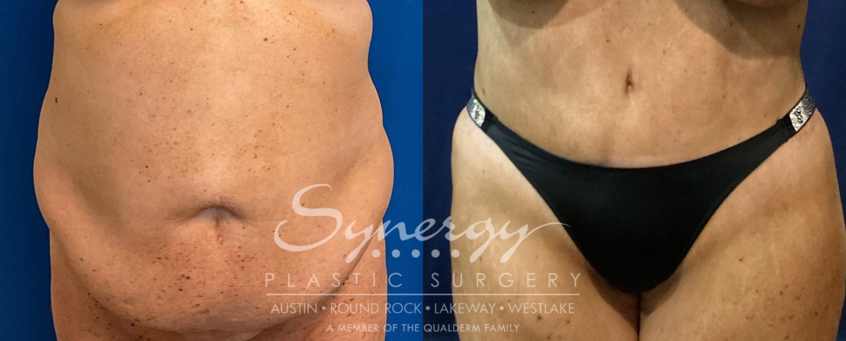 Before & After Abdominoplasty (Tummy Tuck) Case 937 Front View in Austin, TX