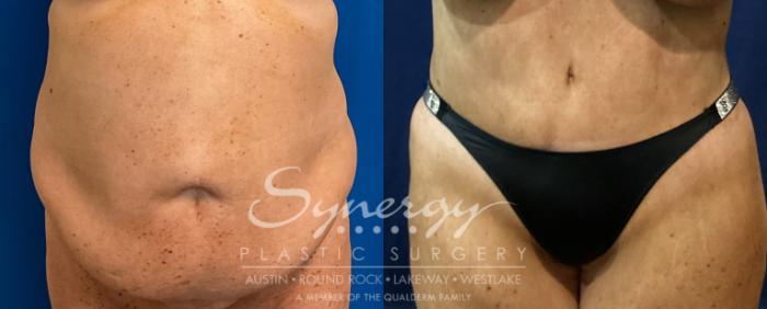 Before & After Abdominoplasty (Tummy Tuck) Case 937 Front View in Austin, TX