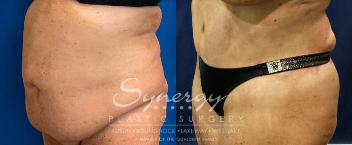 Before & After Abdominoplasty (Tummy Tuck) Case 937 Left Oblique View in Austin, TX