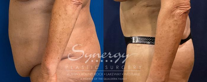 Before & After Abdominoplasty (Tummy Tuck) Case 937 Left Side View in Austin, TX