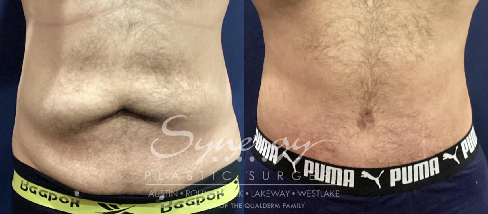 Before & After Abdominoplasty (Tummy Tuck) Case 938 Front View in Austin, TX