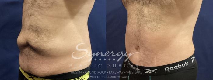 Before & After Abdominoplasty (Tummy Tuck) Case 938 Left Oblique View in Austin, TX