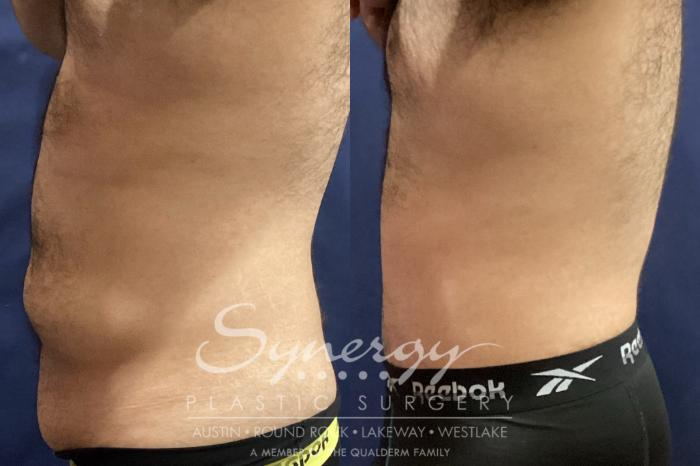 Before & After Abdominoplasty (Tummy Tuck) Case 938 Left Side View in Austin, TX