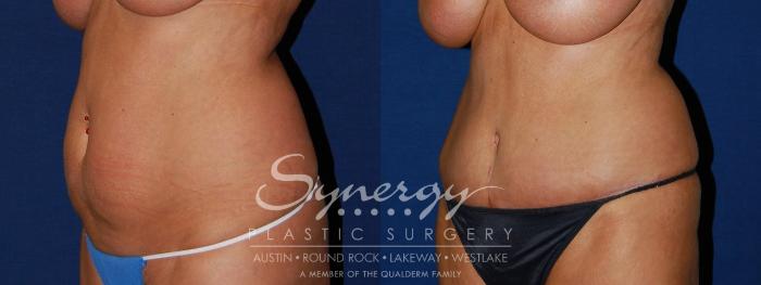 Before & After Abdominoplasty (Tummy Tuck) Case 95 View #3 View in Austin, TX