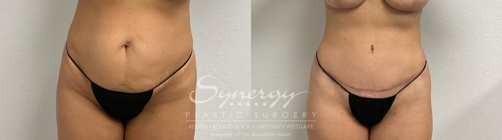 Before and after tummy tuck results showing improved abdominal contour and tightened skin.
