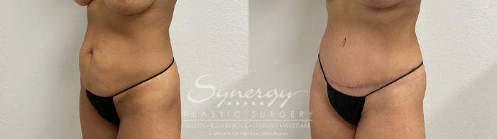 Before and after tummy tuck results showing improved abdominal contour and tightened skin.