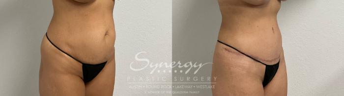 Before and after tummy tuck results showing improved abdominal contour and tightened skin.