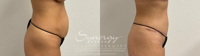 Before and after tummy tuck results showing improved abdominal contour and tightened skin.