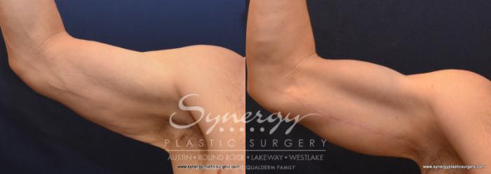 Before & After  Case 600 View #2 View in Austin, TX