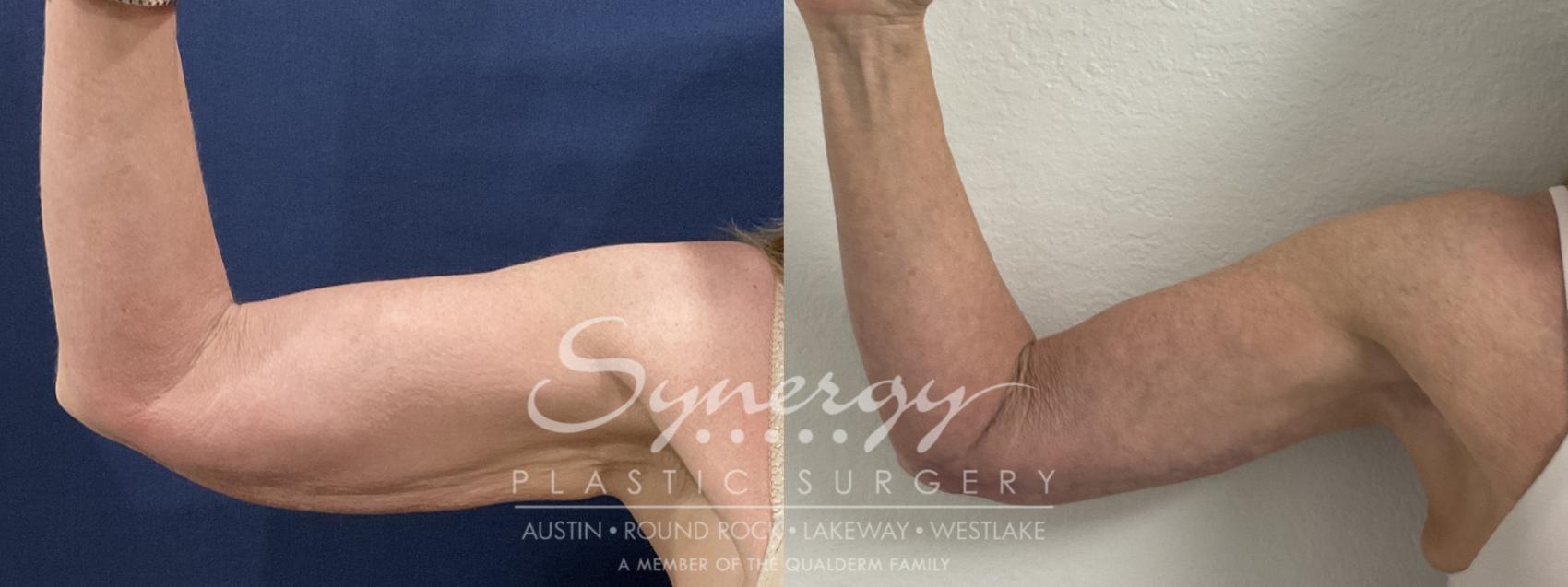 Before & After  Case 911 Front Right View in Austin, TX