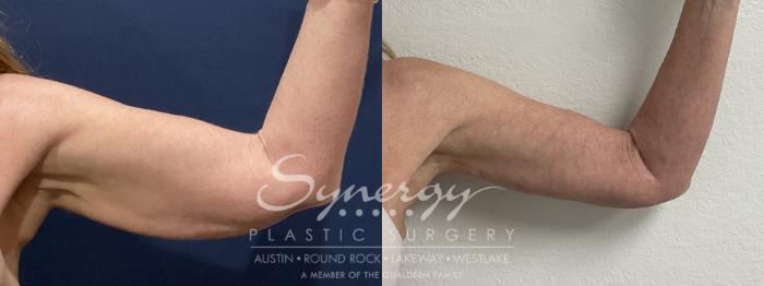 Before & After  Case 911 Right Left View in Austin, TX