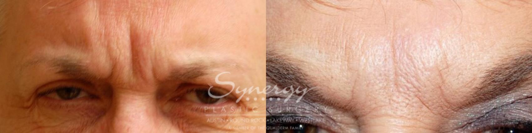 Before & After BOTOX® Cosmetic & Dysport® Case 21 View #1 View in Austin, TX