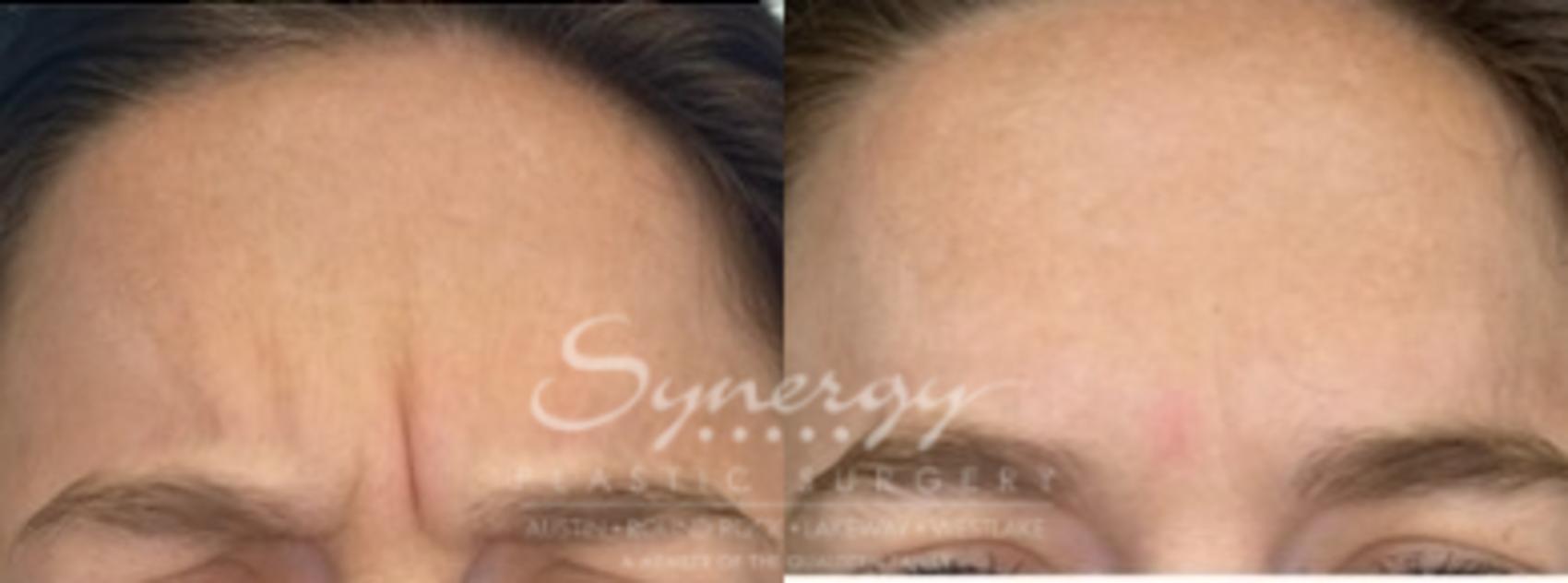 before and after botox