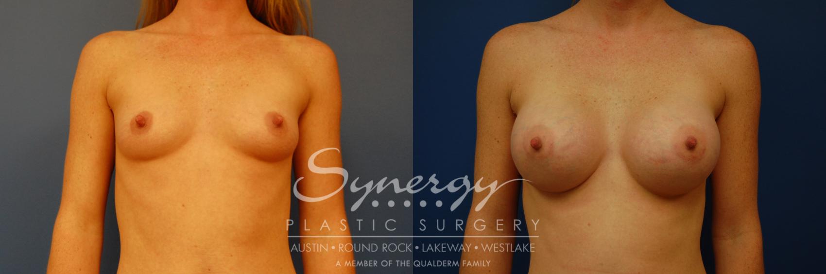 Before & After Breast Augmentation Case 1 View #1 View in Austin, TX