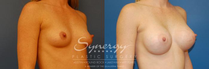 Before & After Breast Augmentation Case 1 View #2 View in Austin, TX