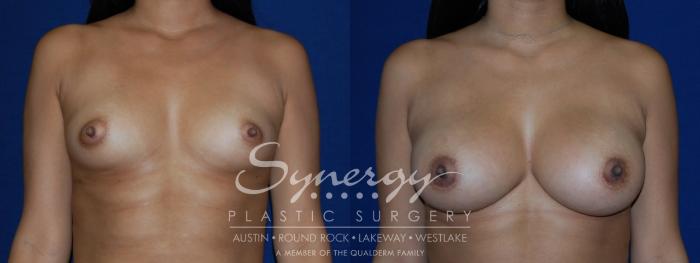 Before & After Breast Augmentation Case 100 View #1 View in Austin, TX