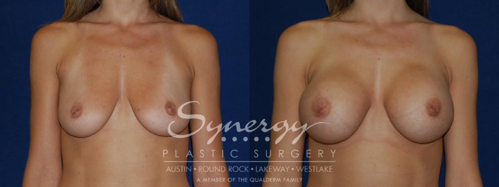 Before & After Breast Augmentation Case 104 View #1 View in Austin, TX
