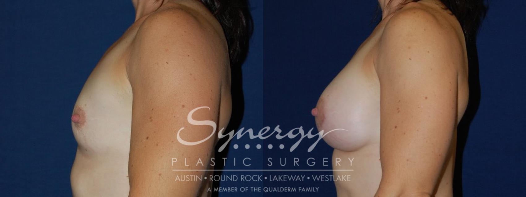 Before & After Breast Augmentation Case 108 View #1 View in Austin, TX