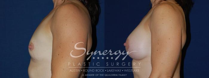 Before & After Breast Augmentation Case 108 View #1 View in Austin, TX