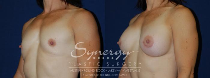 Before & After Breast Augmentation Case 108 View #2 View in Austin, TX