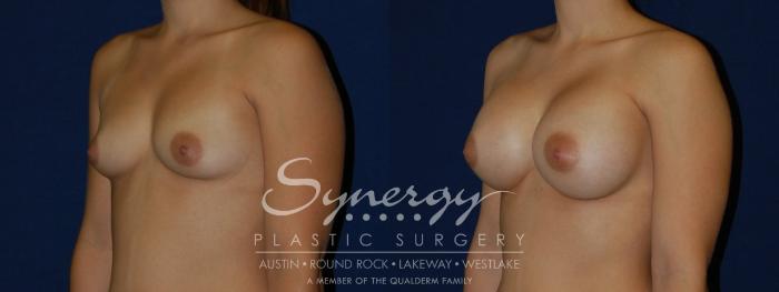 Before & After Breast Augmentation Case 117 View #2 View in Austin, TX