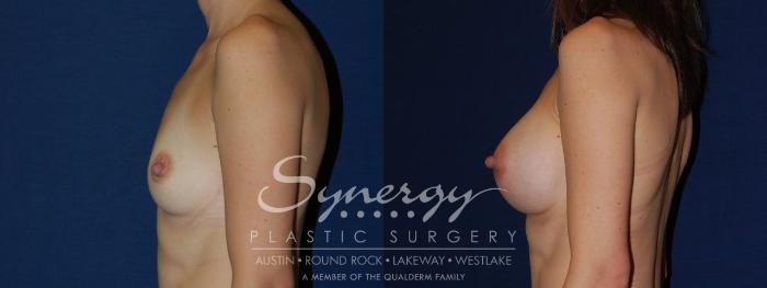 Before & After Breast Augmentation Case 119 View #1 View in Austin, TX