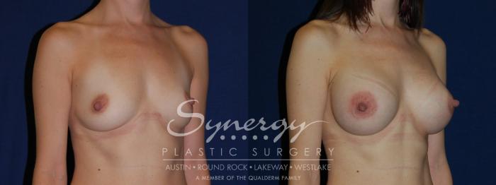 Before & After Breast Augmentation Case 119 View #2 View in Austin, TX