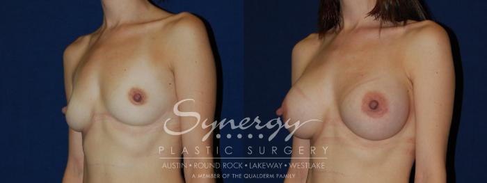 Before & After Breast Augmentation Case 119 View #3 View in Austin, TX