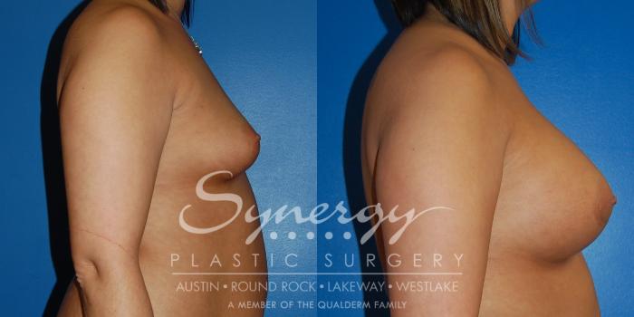 Before & After Breast Augmentation Case 12 View #5 View in Austin, TX