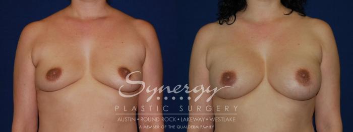 Before & After Breast Augmentation Case 121 View #1 View in Austin, TX