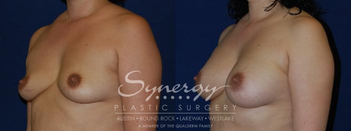 Before & After Breast Augmentation Case 121 View #3 View in Austin, TX