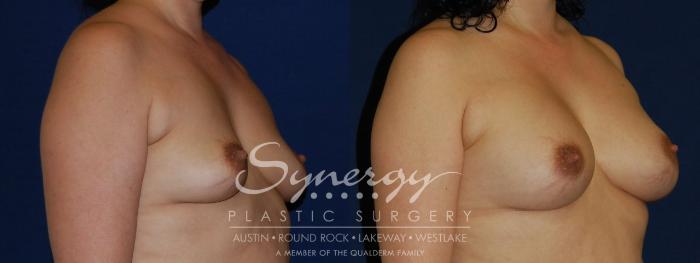 Before & After Breast Augmentation Case 121 View #4 View in Austin, TX